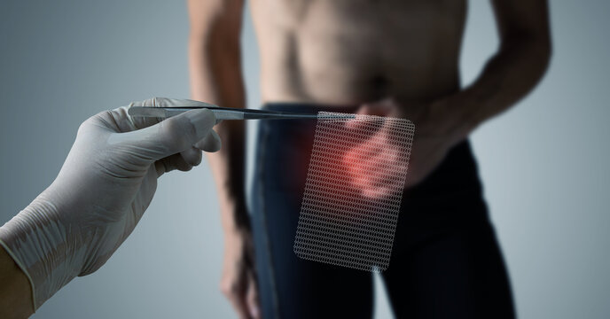 A man presents with abdominal pain from a hernia as a surgeon presents surgical mesh to treat the condition.