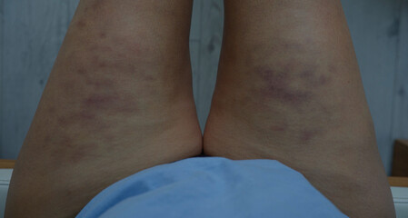 Bruises on the hips and thighs after cellulite treatments