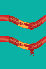 Illustration of artery plaque buildup and rupture causing blood leakage and vascular damage. eps 10