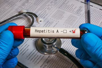 Doctor holding test tube showing positive result for hepatitis a virus