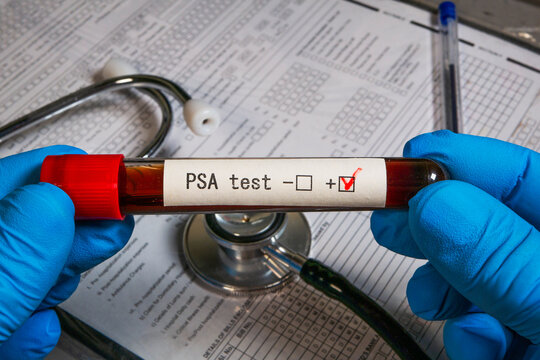 Doctor holding test tube with psa test result and stethoscope on medical form