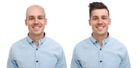 Baldness. Man before and after wearing wig or hair treatment, collage