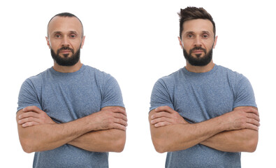 Baldness. Man before and after wearing wig or hair treatment, collage