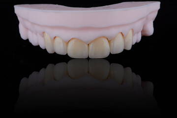 High-quality six dental crowns made of zirconium for fixation to the frontal teeth of upper jaw.