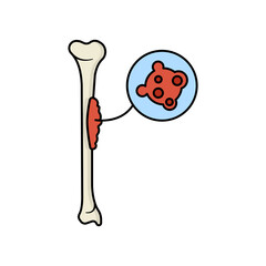 Bone cancer