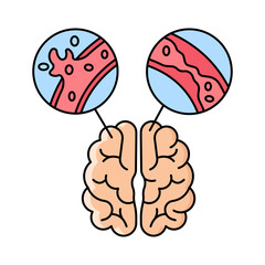 Brain stroke disease illustragtion