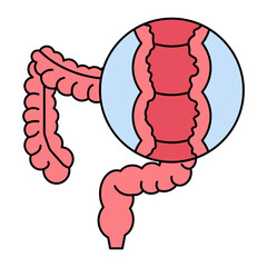 Colon Crohn's Disease illustration