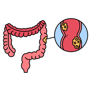 Colorectal Cancer disease illustration