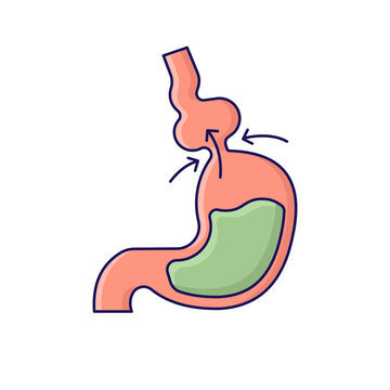 Hiatal Hernia Disease illustration