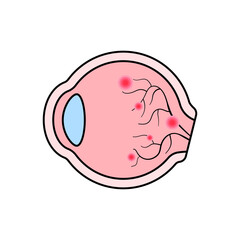 Diabetic Rethinopathy disease