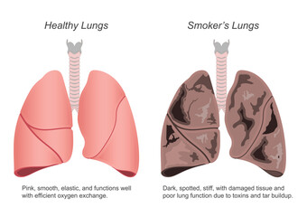 Healthy Lung and Smokers Lung isolated on white.