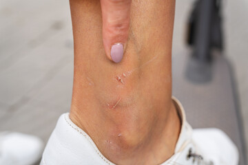 Close-up of a woman's ankle showing several small abrasions and scrapes, indicating a minor injury
