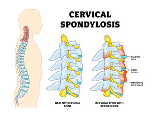 Cervical Spondylosis, Spine Structure Anatomy, Spinal Disease Educational Medical Poster Design Healthcare Scheme, Labeled Disc Degeneration, Bulging Disk, Bone Spurs, Arthritis, Inflammation Vertebra