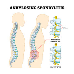 Ankylosing Spondylitis or Bamboo Spine Spinal Disease, Educational Medical Poster Design Healthcare Scheme, Labeled Fused Vertebrae, Human Chronic Inflammation Backbone Structure Anatomy.