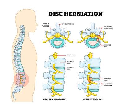 Disc Herniation with Spinal Bone Spine Disease Educational Medical Poster Design Healthcare Scheme, Labeled Compressed Spinal Nerves, Articular Process, Spinous Process, Vertebral Body Disk.