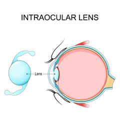 IOL implant position and location in eye