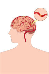 Medical diagram showing cerebral artery obstruction causing ischemic stroke in the brain.