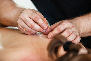  Chinese medicine. Close-up of a doctor's hands doing acupuncture