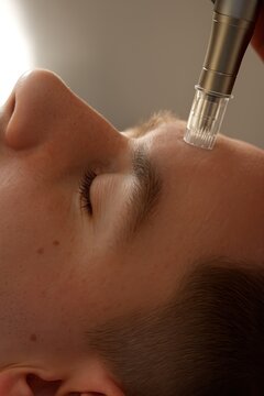 Close-up of a microneedling session on a man&rsquo;s forehead using a professional dermapen device. The man&rsquo;s eyes are closed, and the skin is clean and well-lit.
