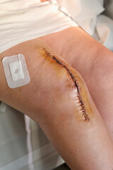 Knee with a large recent scar sutured with staples after knee replacement surgery in an unrecognizable elderly woman. Postoperative phase after knee joint arthroplasty.
