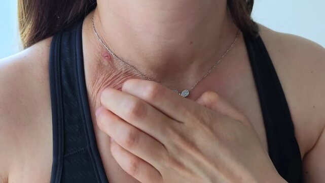 Skin problem and beauty. Young woman scratch body has itchy skin from skin allergic, steroid allergy, sensitive skin, red from sunburn, chemical allergy, rash, insect bites, Seborrheic Dermatitis.