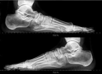 Obraz premium X-ray showing healthy human foot bones and joints. Both sides view