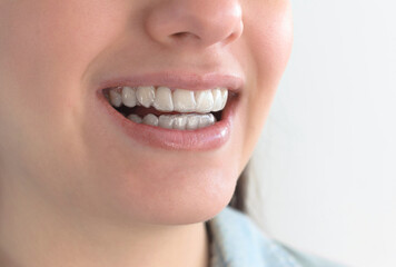 Obraz premium Contenciones dentales removibles post tratamiento de ortodoncia con alineadores invisibles.