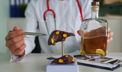 Doctor examines liver model while holding a bottle of alcohol in medical