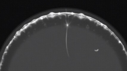 Ultrasound scan image of the eye