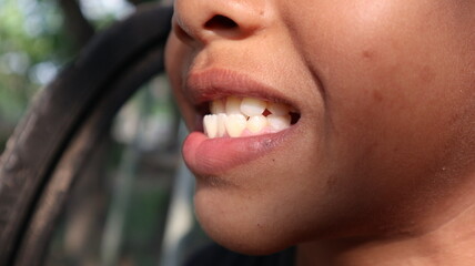 Kid patient open mouth showing cavities teeth decay. Child smile and show her crowding tooth. Close...