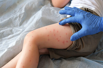 Doctor examining child with bodily red rash. Kid allergy closeup. Little baby scratches an eruption. Nurse applies special cream to atopic skin. Dermatitis, irritation, hive. Pruritus. Mosquito bites
