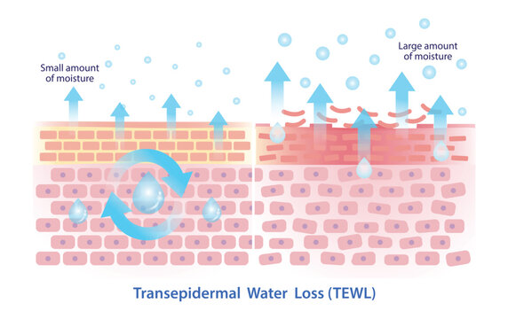 Comparison of transepidermal water loss illustration isolated on white background. Skin barrier in healthy state, TEWL small amount of moisture and damaged skin state, TEWL large amount of moisture.