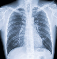 40代男性の胸部X線写真
