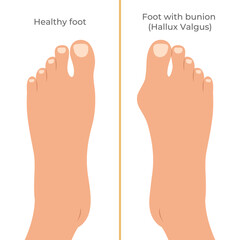 Healthy foot and foot with a Hallux valgus deformation. Bunion of a big toe. Vector illustration