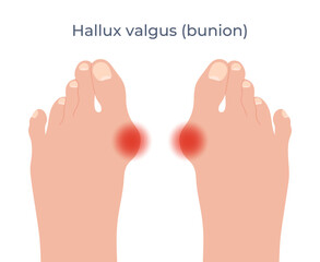 Feet with a bunion of a big toe. Hallux valgus deformation. Vector illustration