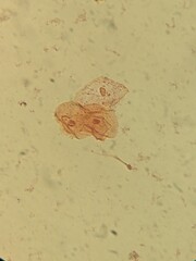 Urine specimen stained with safranin showing cells and crystals