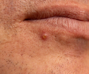 acne on male facial skin.