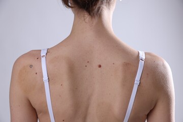 Woman with moles on her body against light background, closeup