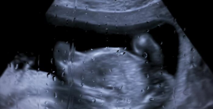 Ultrasound screen showing detailed image of a fetus during prenatal medical examination
