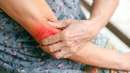 Close up of elderly woman holding painful red swollen elbow indicating joint inflammation arthritis or allergic skin reaction