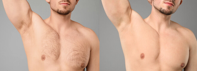 Before and after epilation. Collage with photos of man showing armpit and chest on grey background, closeup