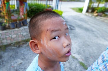The boy turned his face to the side to show the scars from his mischief.