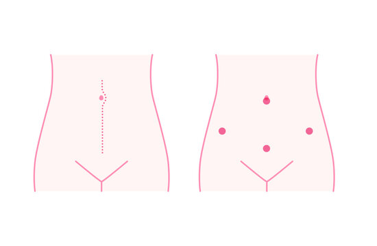 婦人科手術後の腹部イメージ（開腹手術・腹腔鏡手術）