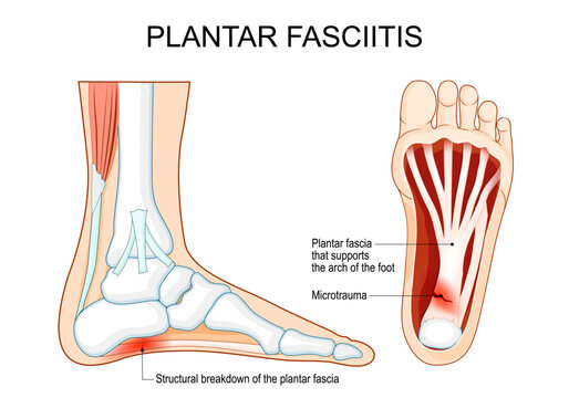 Plantar fasciitis. Heel pain. Human foot