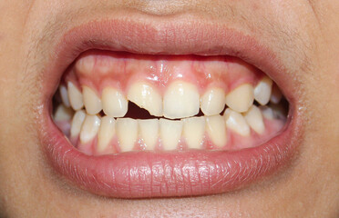 Close-up of a broken tooth with visible cracks and damage. The fractured enamel and dentin expose...