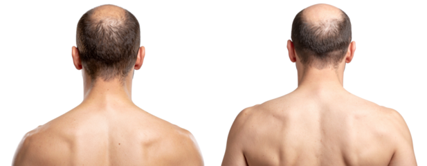 Rear Profile of Bald Male Scalp Transparent Background