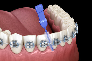 Interdental tooth brush and braces cleaning. 3D illustration of oral hygiene.