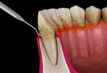 Oral hygiene: Scaling and root planing of Periodontitis (conventional periodontal therapy). 3D illustration