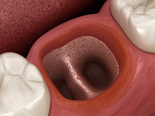 Alveolits - opened dry soket after tooth extraction. Dental 3D illustration