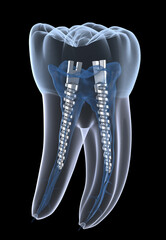 Dental steel post inside molar teeth, Xray view. Dental endodontic treatment 3D illustration